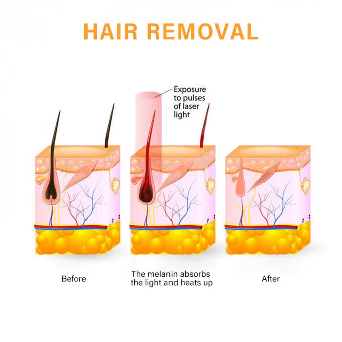Retiro profesional del pelo del laser del diodo del alexandrite 808 de la depilación del retiro del pelo de la máquina del laser